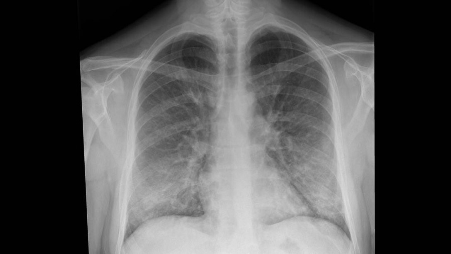 Imagem do exame de raio-x de um pulmão. Cigarros.